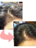 幹細胞を使用した育毛促進