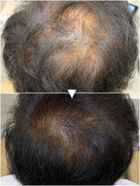 レヴィア(revia)&nbsp;プレミアム育毛促進美髪コース×4ヶ月(3週周期)の効果