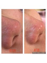 アコ(aco)&nbsp;毛穴のお掃除