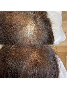 ラキ(laki) 強髪スパ