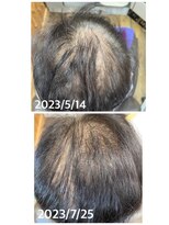 エミ(EMI)&nbsp;育毛促進