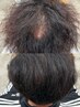 髪と頭皮のエイジングケア無料カウンセリング