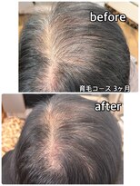 エミ(EMI)&nbsp;育毛促進