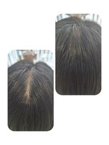 ユーフォルムギンザ(y-Forme Ginza) 話題のトキカタ♪頭頂部編