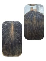 ユーフォルムギンザ(y-Forme Ginza)&nbsp;話題のトキカタ♪頭頂部編