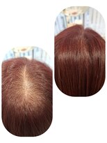 ユーフォルムギンザ(y-Forme Ginza)&nbsp;話題のトキカタ♪頭頂部編