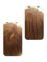 ユーフォルムギンザ(y-Forme Ginza)&nbsp;話題のトキカタ♪頭頂部編