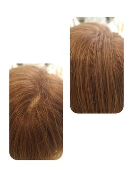 ユーフォルムギンザ(y-Forme Ginza) 話題のトキカタ♪頭頂部編