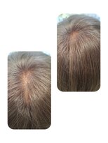 ユーフォルムギンザ(y-Forme Ginza) 話題のトキカタ♪頭頂部編