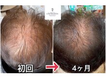 クレマチス(Clematis)の雰囲気(80代・女性のお客様♪頭皮が見えにくくなり喜ばれております)