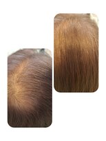 ユーフォルムギンザ(y-Forme Ginza) 話題のトキカタ♪頭頂部編