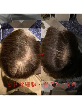 シー 豊川店(She) 幹細胞を使った育毛促進 30代、40代、50代