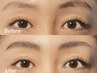 BROW LIFT
