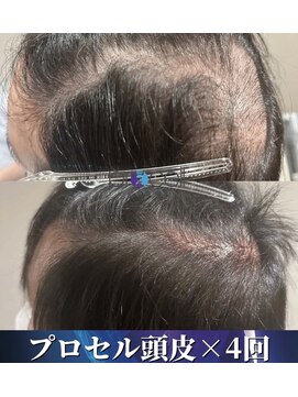 サロン モーリー(salon morley) プロセラセラピーズ 頭皮トリートメント