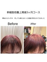 髪質改善 ソアリス 烏丸丸太町店(soiris)&nbsp;50代のお客様/幹細胞上清液3ヶ月育毛促進コース　生え際細毛悩み
