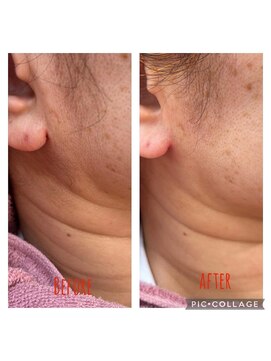 アコ(aco) シェービング