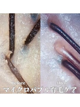 ヘアープレゴ(hair Prego) マイクロバブル育毛促進ケアBefore&After