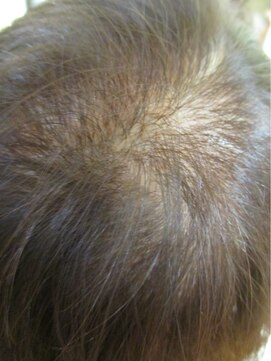 ヨシユキコンディショニング エイジレス 特許「つむじ補正」 つむじ、分け目が目立つ方31