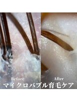 ヘアープレゴ(hair Prego)&nbsp;マイクロバブル育毛促進ケアBefore&After