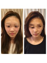 アドール(ADOR)&nbsp;韓国式小顔コルギ