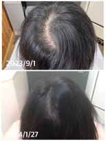 エミ(EMI)&nbsp;育毛促進