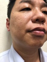 ユニセックスサロンボーロアール(Unisex Salon BEAU ROIRL)&nbsp;メンズ脱毛