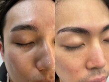 エクファフォーメンホワイト 大津 南草津(EX-FA FOR MEN WHITE)