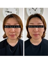ルリエ(Relier)&nbsp;美容鍼ボディーケア60分