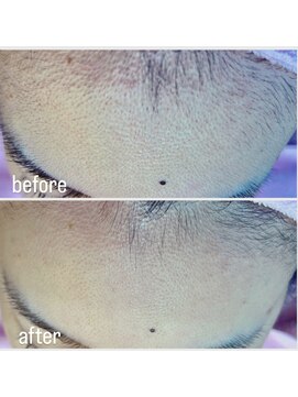 テラス(Terrace) シェービング