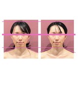 銀座ねむり姫 GINZA east店 お顔は触らないのにほほ、あごがすっきり!目も大きくなりました