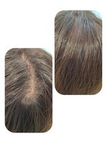 ユーフォルムギンザ(y-Forme Ginza)&nbsp;話題のトキカタ♪頭頂部編