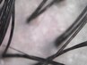 頭皮状態をマイクロスコープを使用して確認