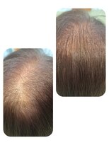 ユーフォルムギンザ(y-Forme Ginza)&nbsp;話題のトキカタ♪頭頂部編