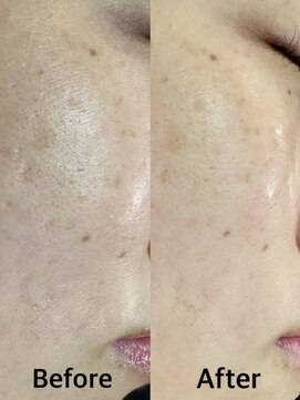 グラスヒビキ レディースシェービングエステ：悩み【ゴワつき、くすみ、乾燥】