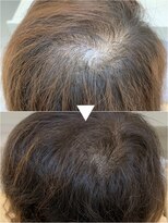 レヴィア(revia)&nbsp;プレミアム育毛促進美髪コース10ヶ月後の効果[水戸/髪質改善]