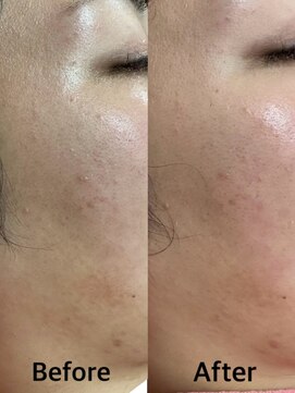 グラスヒビキ レディースシェービングエステ：悩み【ニキビ、肌荒れ】