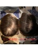 幹細胞を使った育毛促進　30代、40代、50代