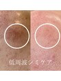 エリア(area)&nbsp;低周波シミケア♪リラックスしながらお肌悩みを解消♪
