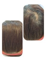 ユーフォルムギンザ(y-Forme Ginza)&nbsp;話題のトキカタ♪頭頂部編