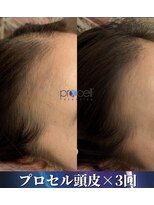 サロン モーリー(salon morley) プロセラセラピーズ頭皮トリートメント