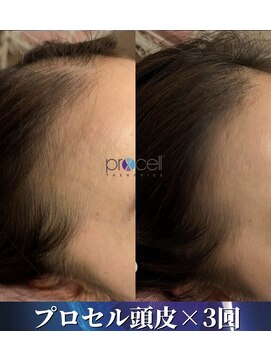 サロン モーリー(salon morley) プロセラセラピーズ頭皮トリートメント
