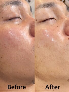 グラスヒビキ メンズシェービングエステ：悩み【脂性肌】