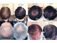 2.育毛・毛髪促進・量の減った毛改善、抜け毛を減らす