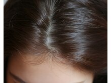頭皮から髪を再構築するヒト幹細胞ケア【富士見台/練馬/ヒト幹細胞】