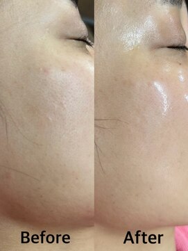 グラスヒビキ レディースシェービングエステ：悩み【くすみ、毛穴の開き】