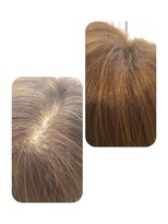 ユーフォルムギンザ(y-Forme Ginza)&nbsp;話題のトキカタ♪頭頂部編