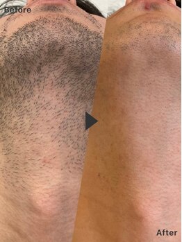 エレガンス(ELEGANCE)の写真/【減毛メニューがオススメ♪】第一印象UPにはヒゲと眉毛のケアがオススメ!痛くならない丁寧なシェービング!