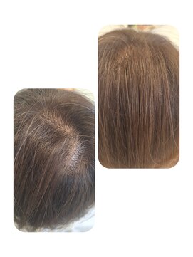 ユーフォルムギンザ(y-Forme Ginza) 話題のトキカタ♪頭頂部編