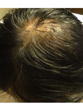 クロコ(CROCO) 細毛コース