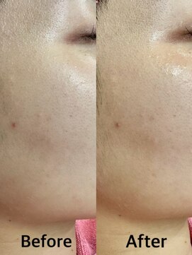 グラスヒビキ レディースシェービングエステ:悩み【ニキビ、毛穴の開き】